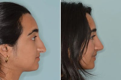 Rhinoplasty before and after, lateral right.