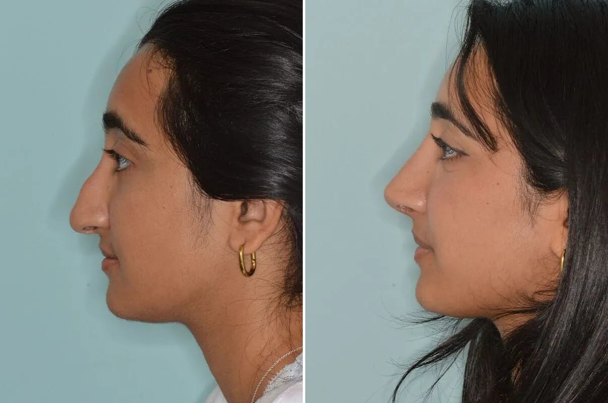 Rhinoplasty before and after, lateral left.
