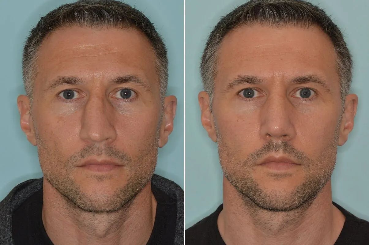 Rhinoplasty before and after, frontal.
