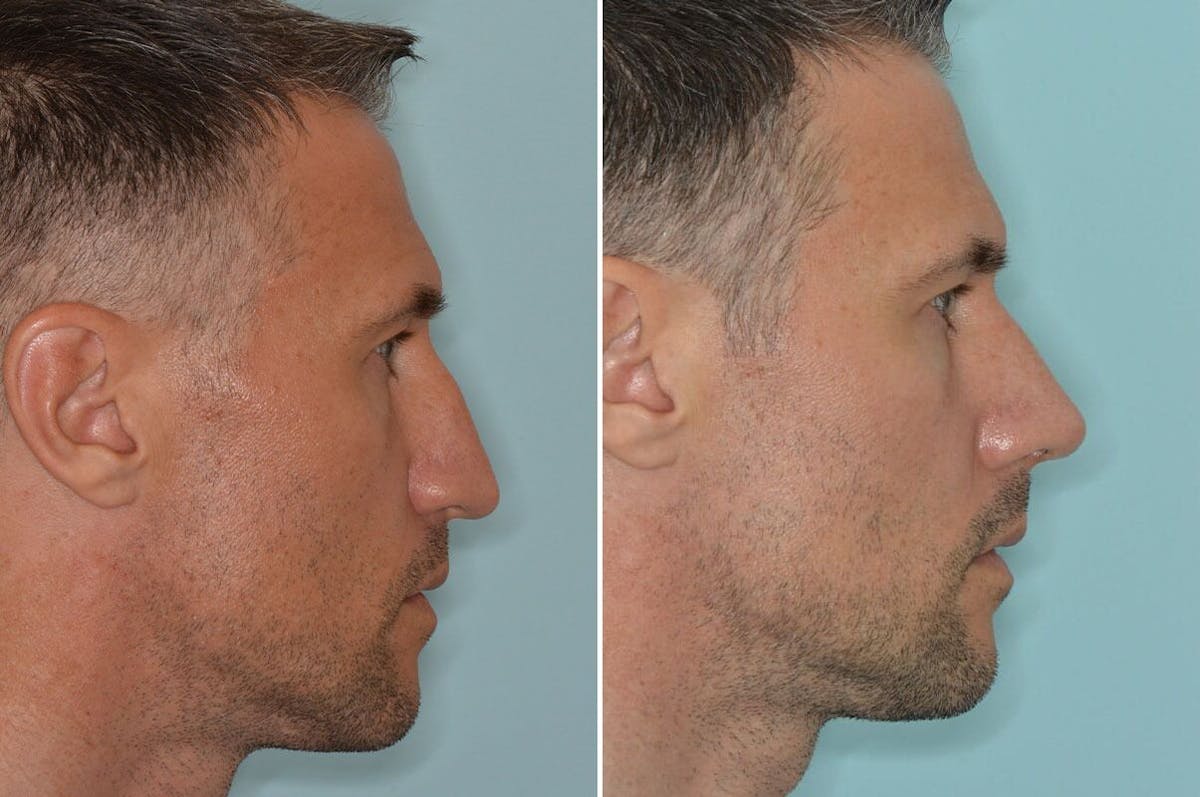 Rhinoplasty before and after, lateral right.