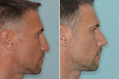 Rhinoplasty before and after, lateral right.
