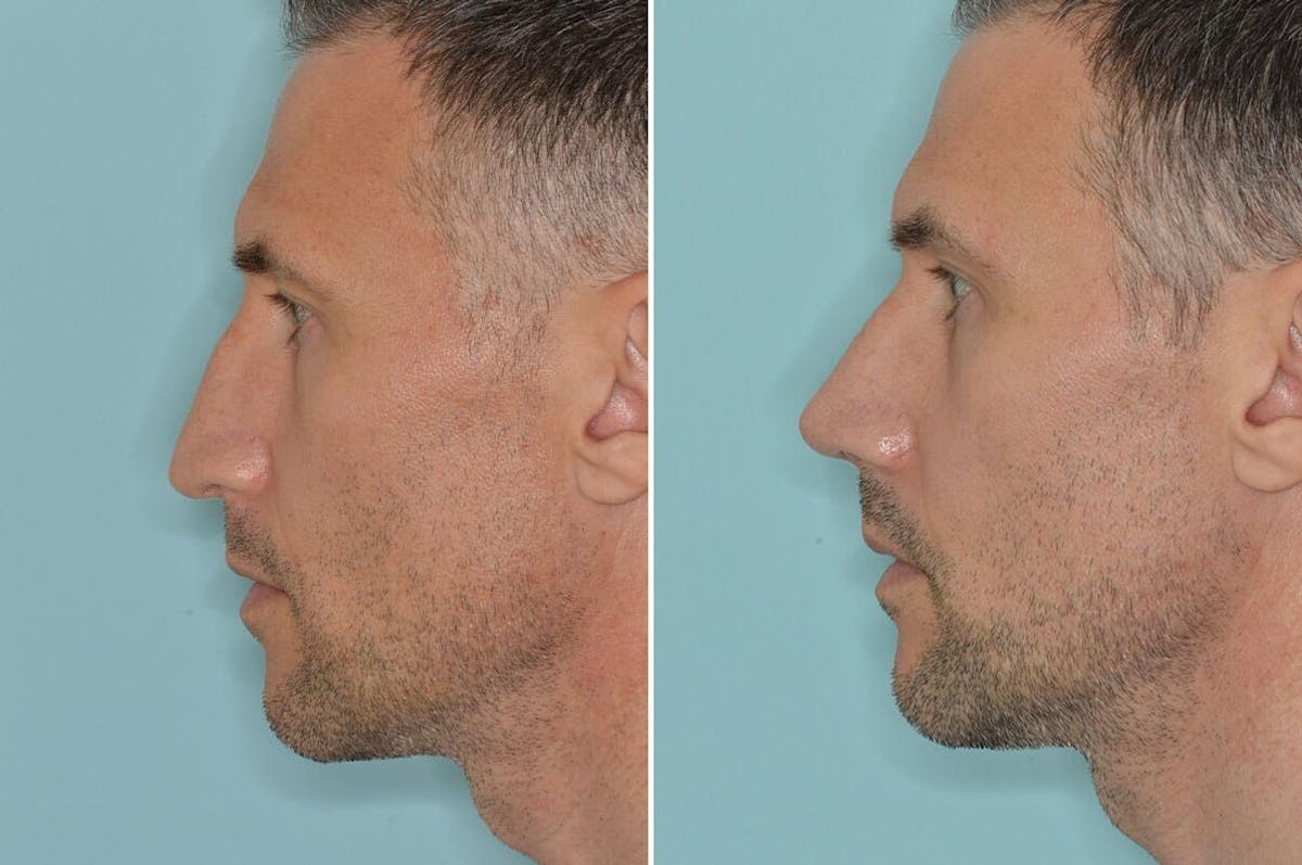 Rhinoplasty before and after, lateral left.