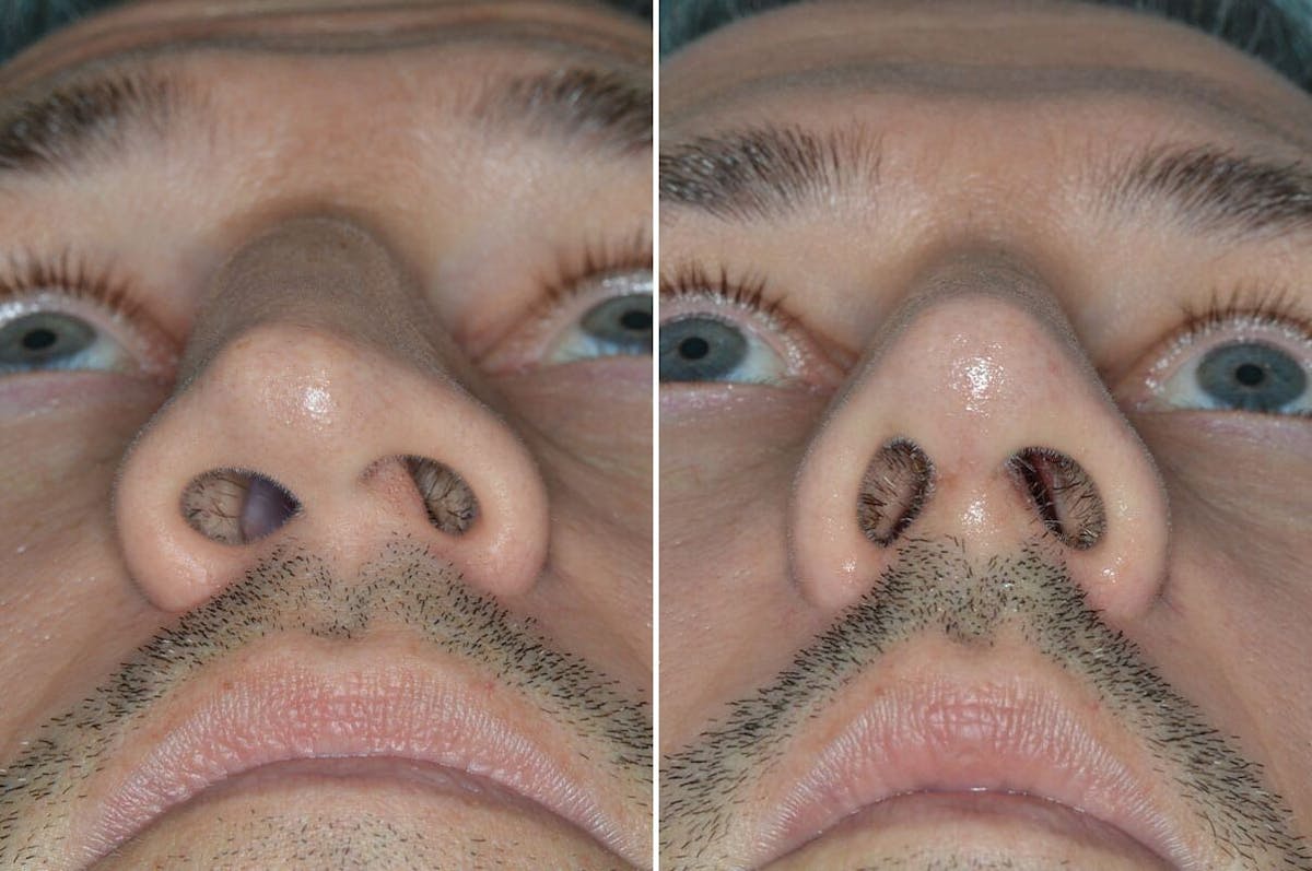 Rhinoplasty before and after, frontal.