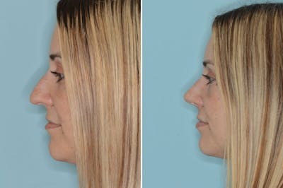 Ethnic Rhinoplasty before and after, lateral left.