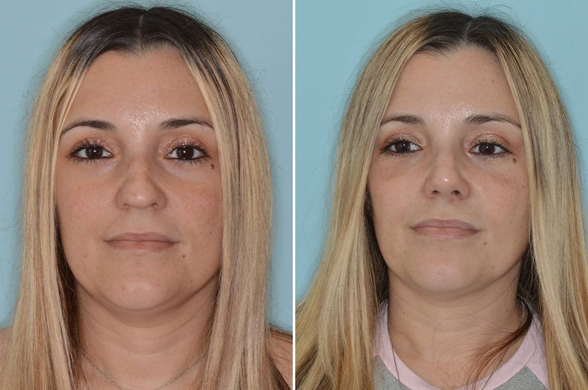Ethnic Rhinoplasty before and after, frontal.