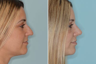 Ethnic Rhinoplasty before and after, lateral right.