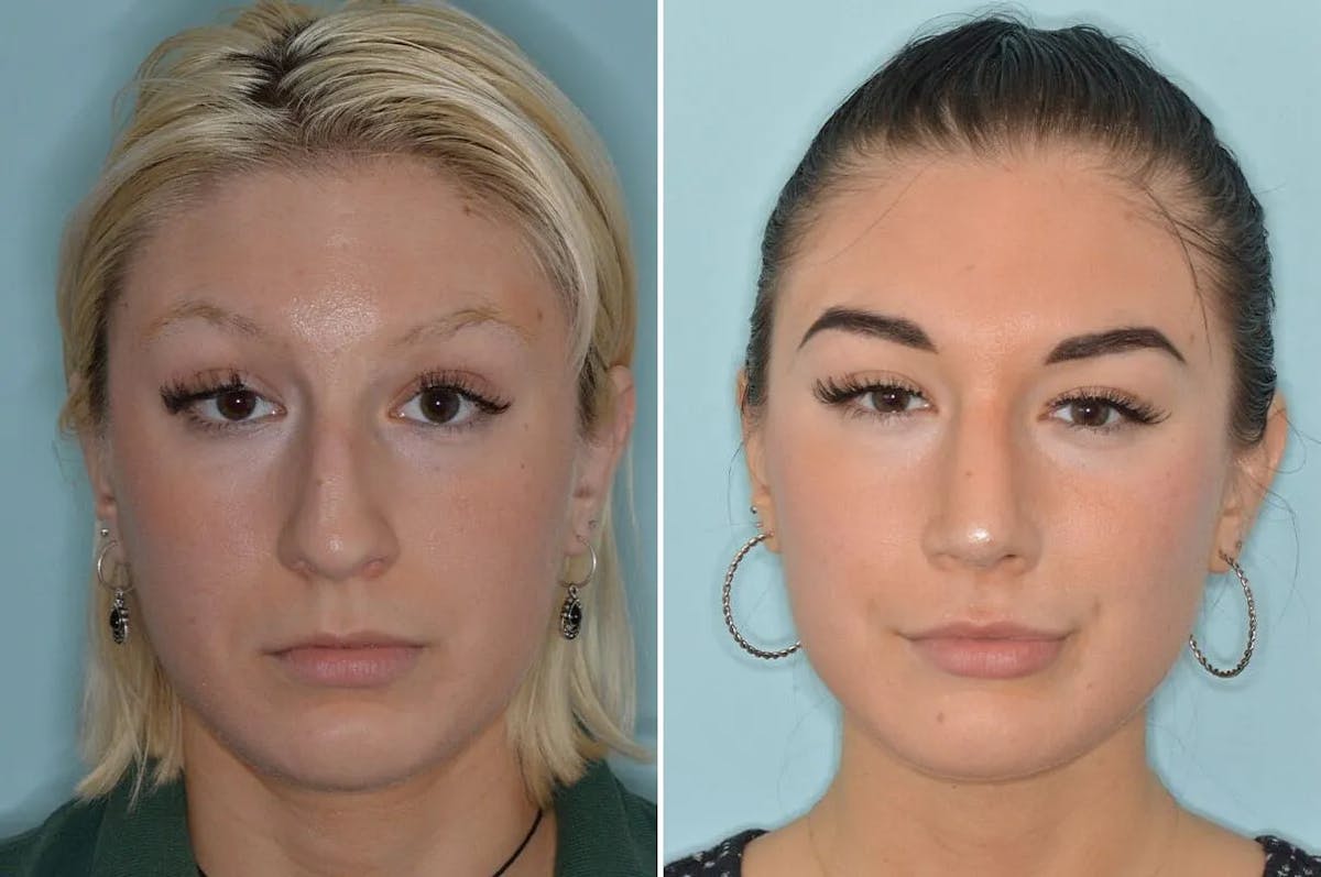Rhinoplasty before and after, frontal.