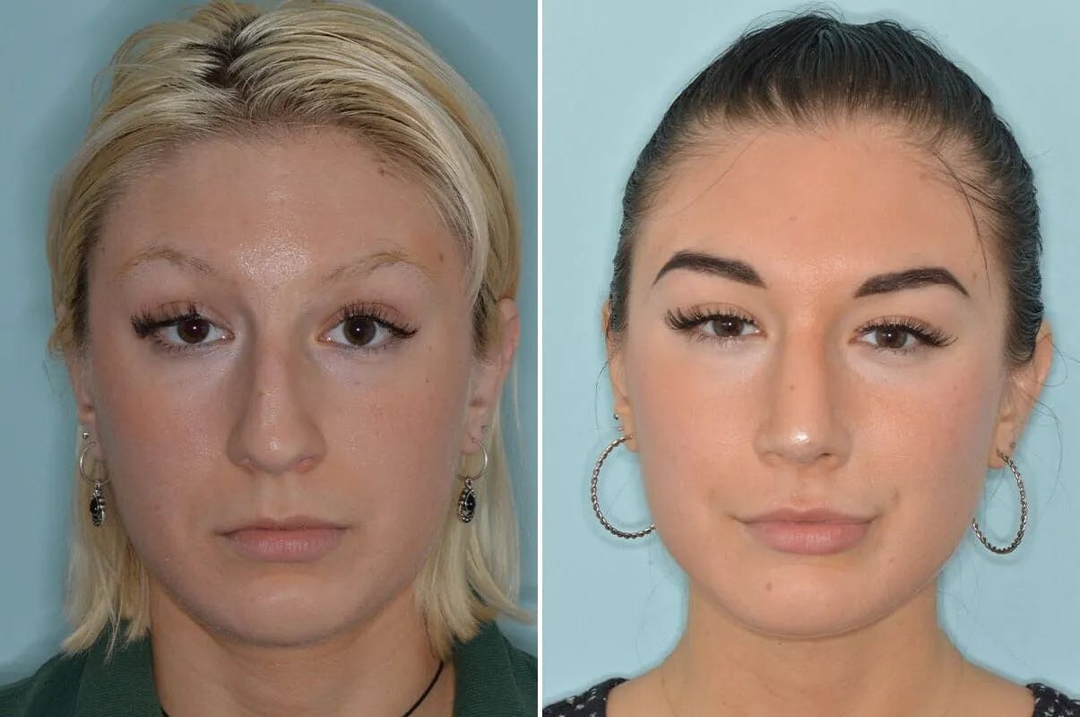 Rhinoplasty before and after, frontal.