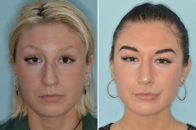 Rhinoplasty before and after, frontal.