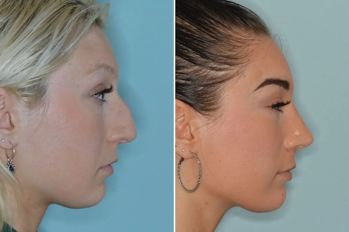 Rhinoplasty before and after, lateral right.
