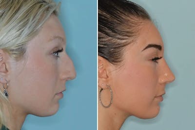 Rhinoplasty before and after, lateral right.