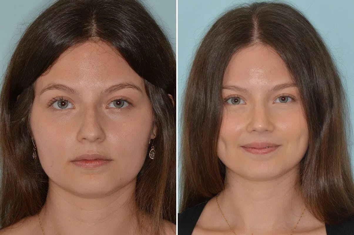 Rhinoplasty before and after, frontal.