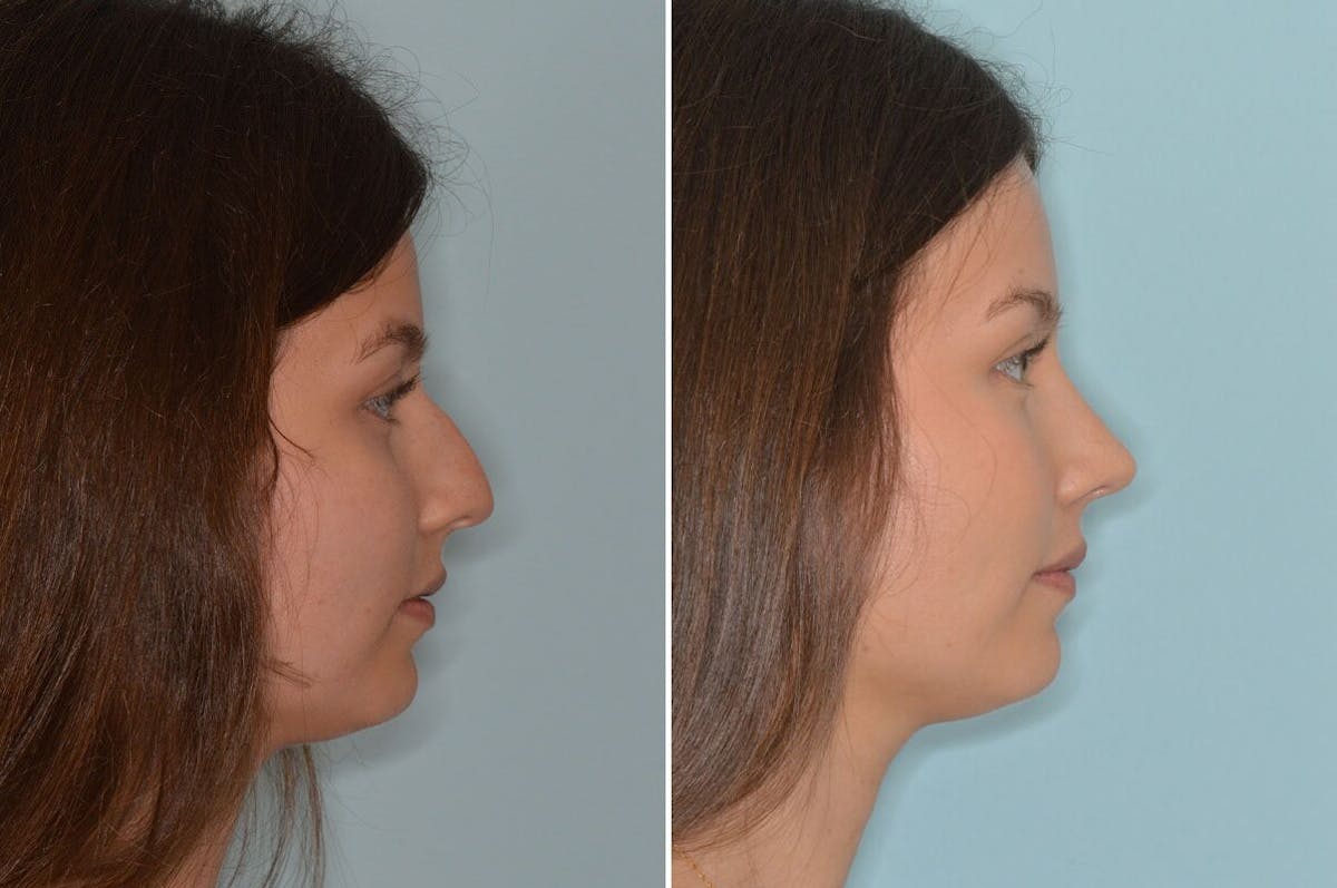 Rhinoplasty before and after, lateral right.