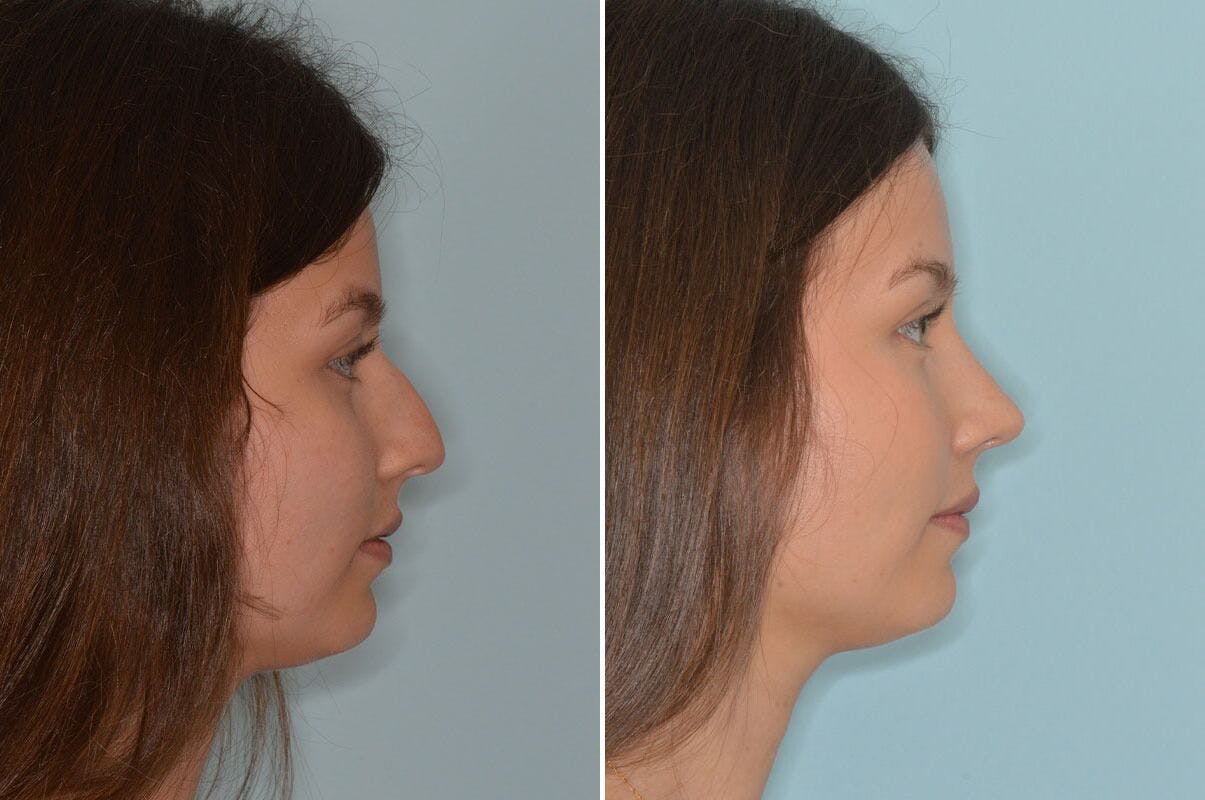 Rhinoplasty before and after, lateral right.