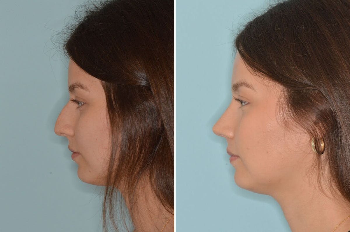 Rhinoplasty before and after, lateral left.
