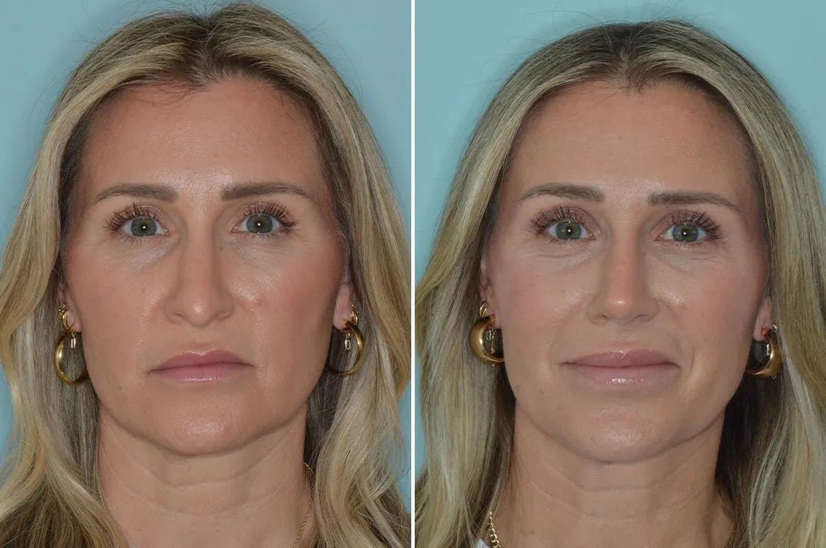 Rhinoplasty before and after, frontal.