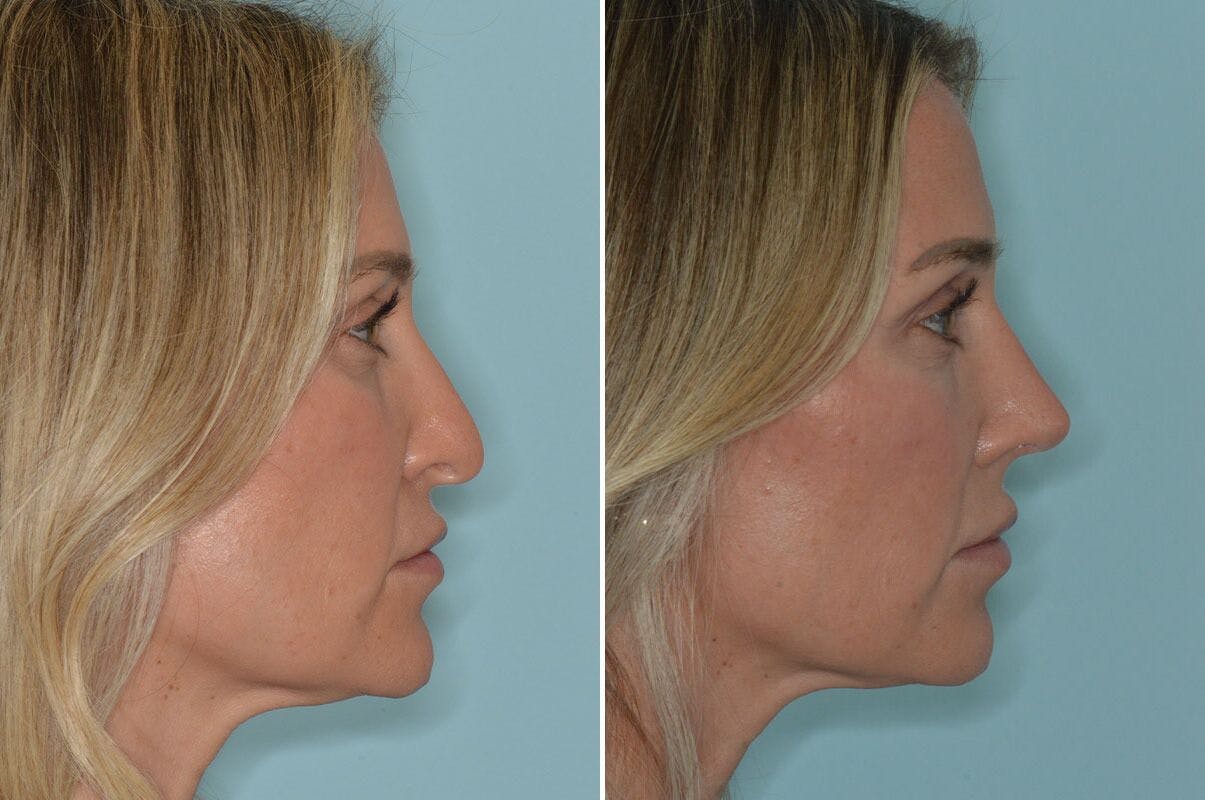 Rhinoplasty before and after, lateral right.