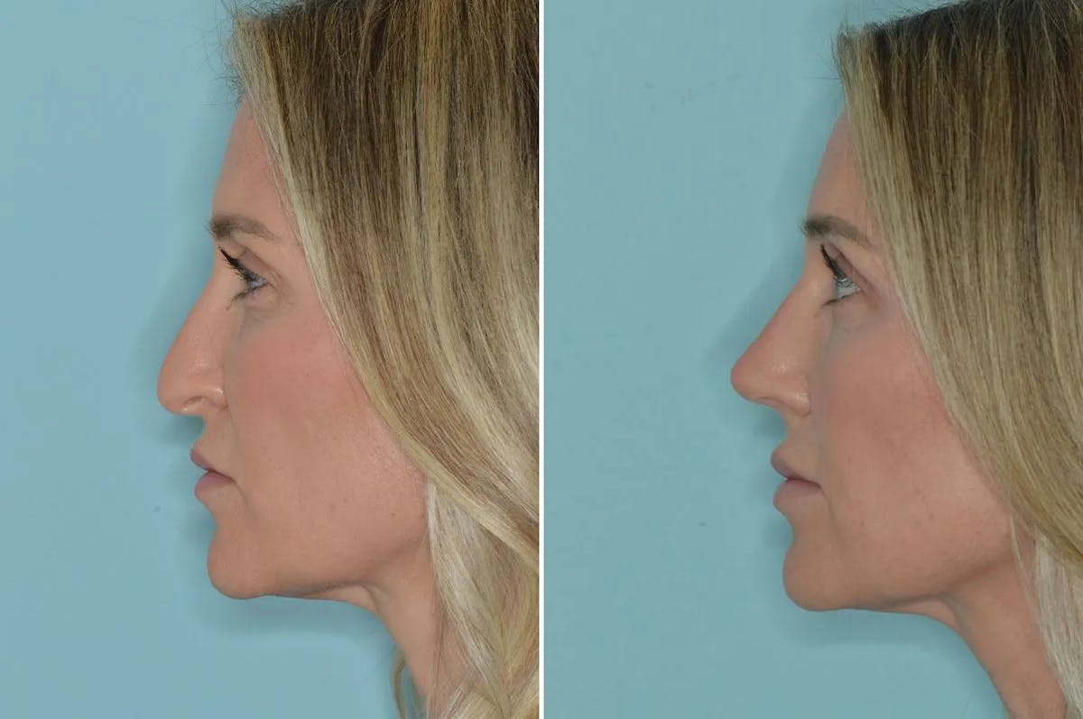 Rhinoplasty before and after, lateral left.