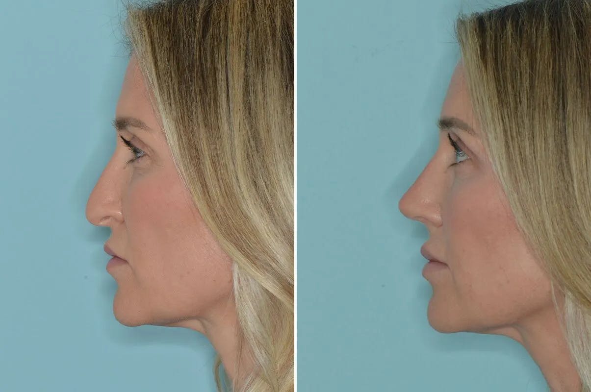 Rhinoplasty before and after, lateral left.
