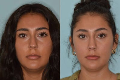 Rhinoplasty before and after, frontal.