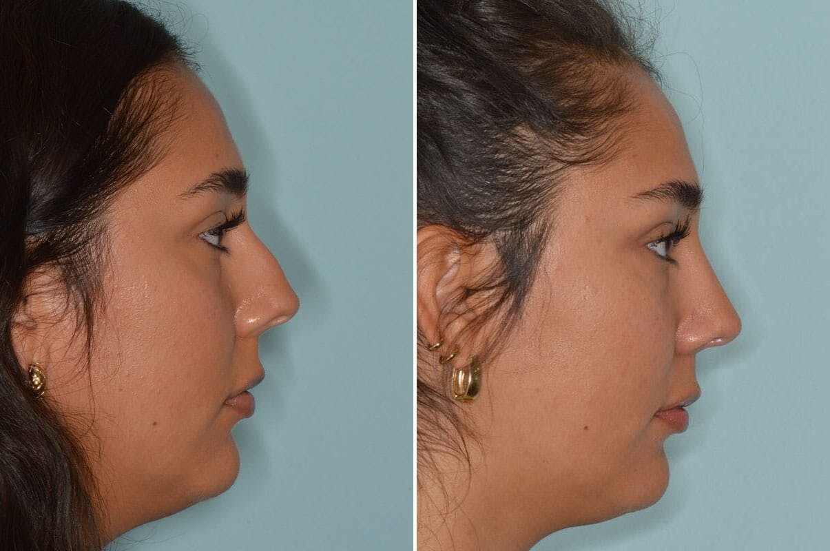 Rhinoplasty before and after, lateral right.