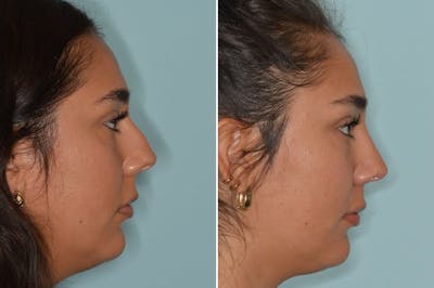 Rhinoplasty before and after, lateral right.