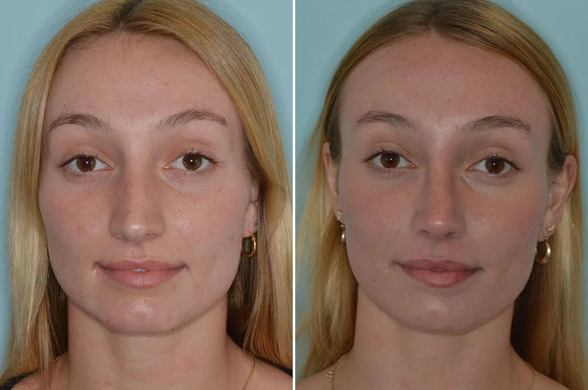 Rhinoplasty before and after, frontal.