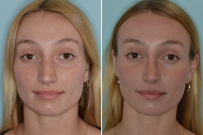 Rhinoplasty before and after, frontal.