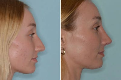 Rhinoplasty before and after, lateral right.