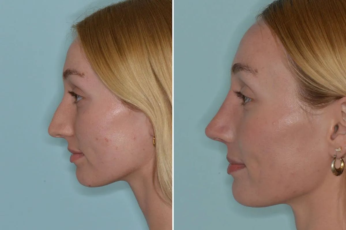 Rhinoplasty before and after, lateral left.