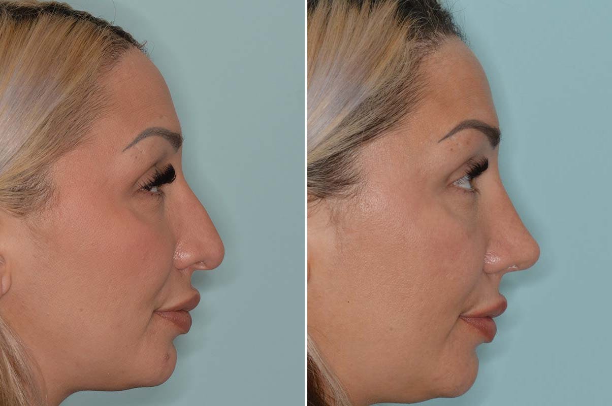 Rhinoplasty before and after, lateral right.