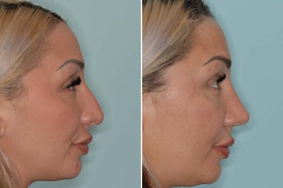 Rhinoplasty before and after, lateral right.
