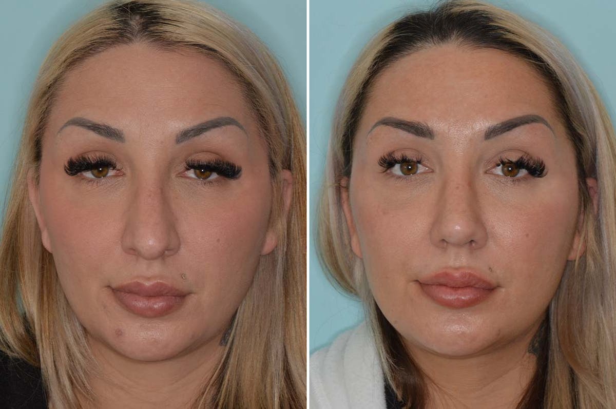 Rhinoplasty before and after, frontal.