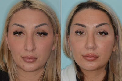 Rhinoplasty before and after, frontal.