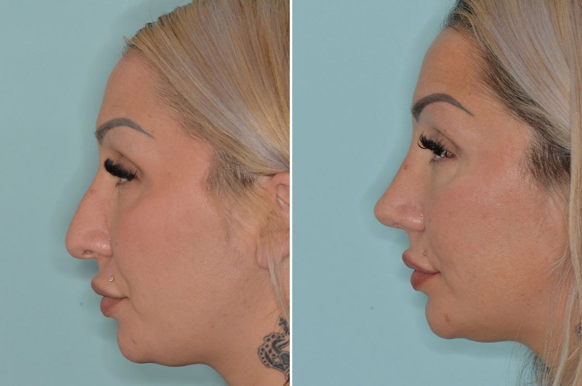 Rhinoplasty before and after, lateral left.