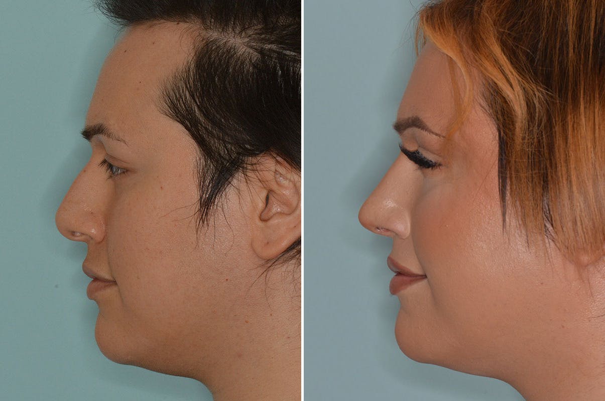 Rhinoplasty before and after, lateral left.