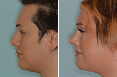 Rhinoplasty before and after, lateral left.