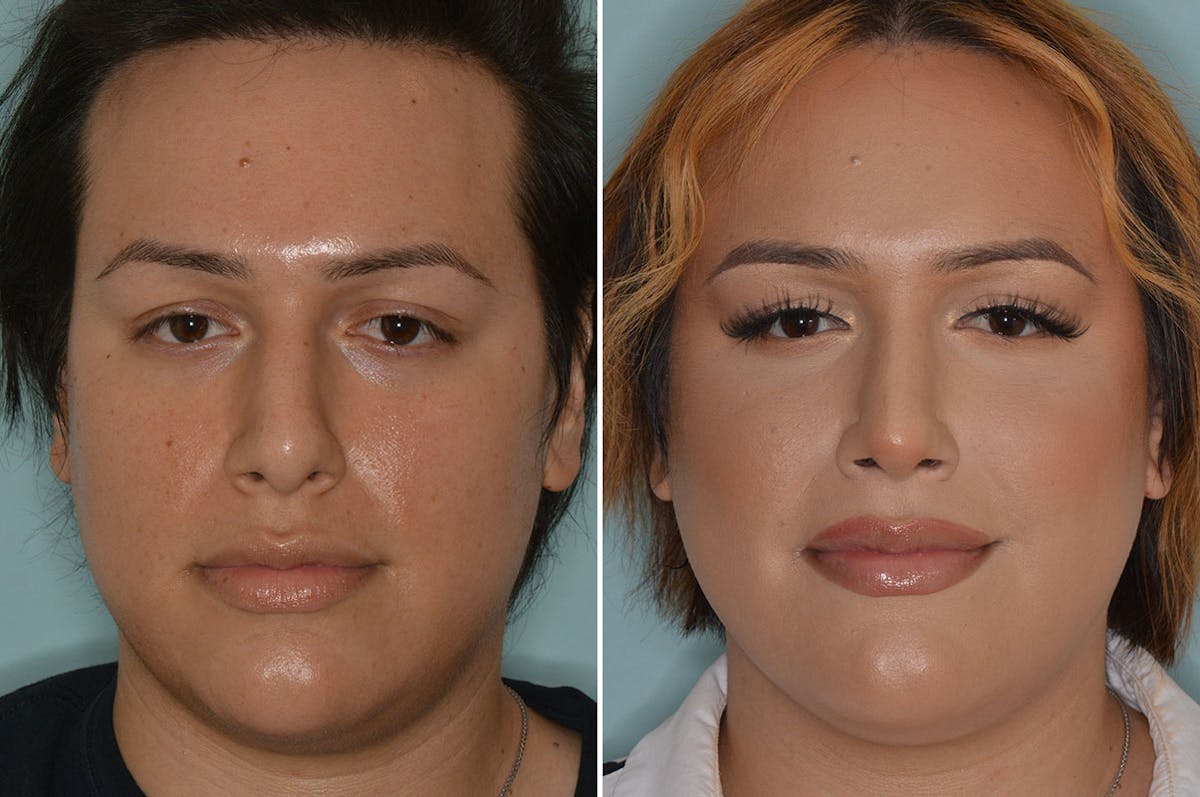Rhinoplasty before and after, frontal.