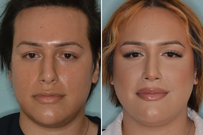Rhinoplasty before and after, frontal.