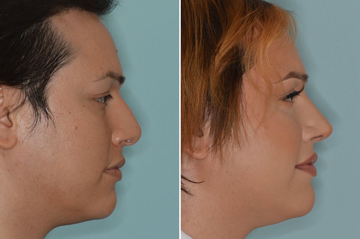 Rhinoplasty before and after, lateral right.