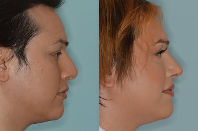 Rhinoplasty before and after, lateral right.