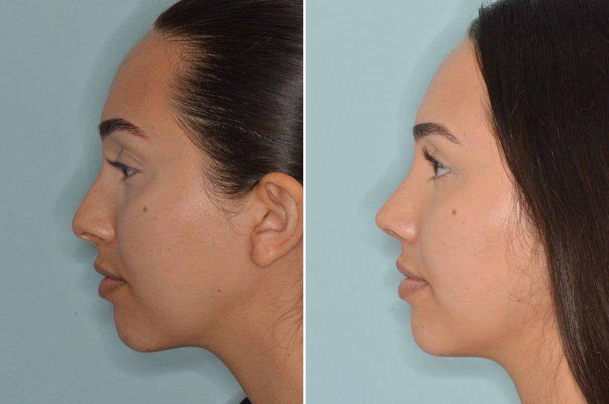 Rhinoplasty before and after, lateral left.