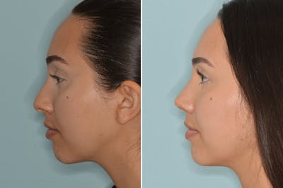 Rhinoplasty before and after, lateral left.