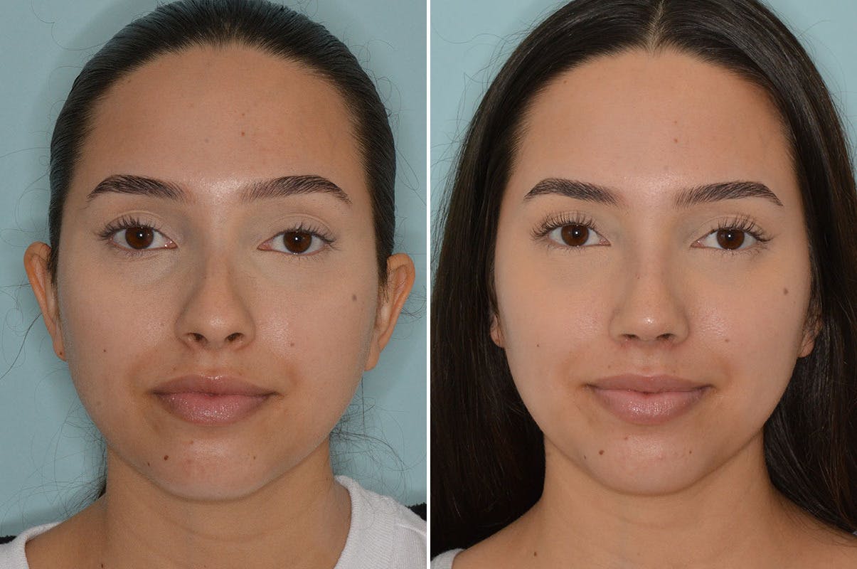Rhinoplasty before and after, frontal.