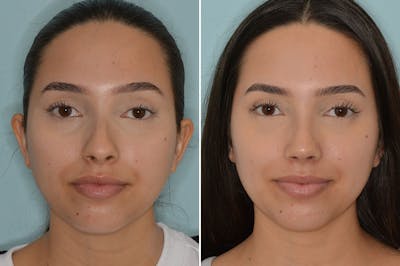 Rhinoplasty before and after, frontal.