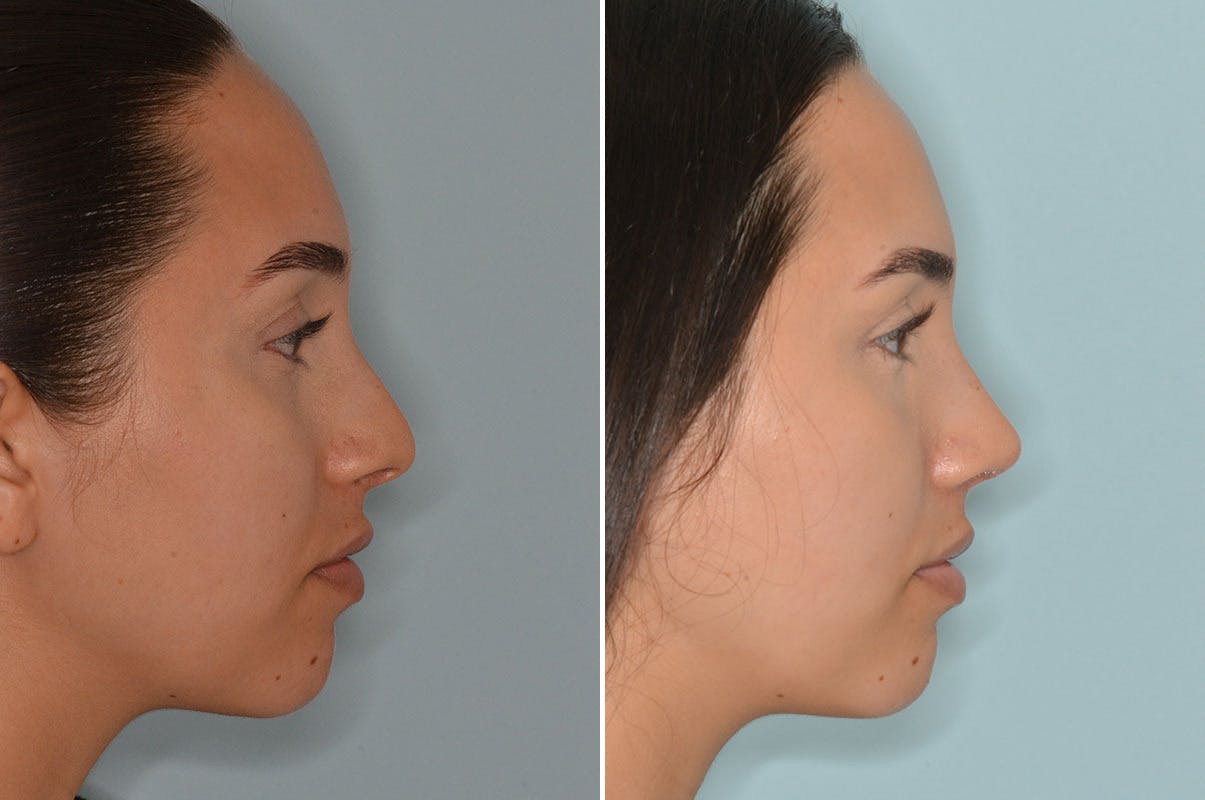 Rhinoplasty before and after, lateral right.