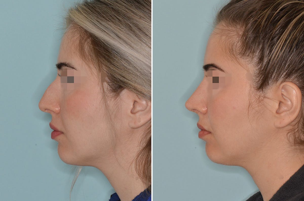 Rhinoplasty before and after, lateral left.