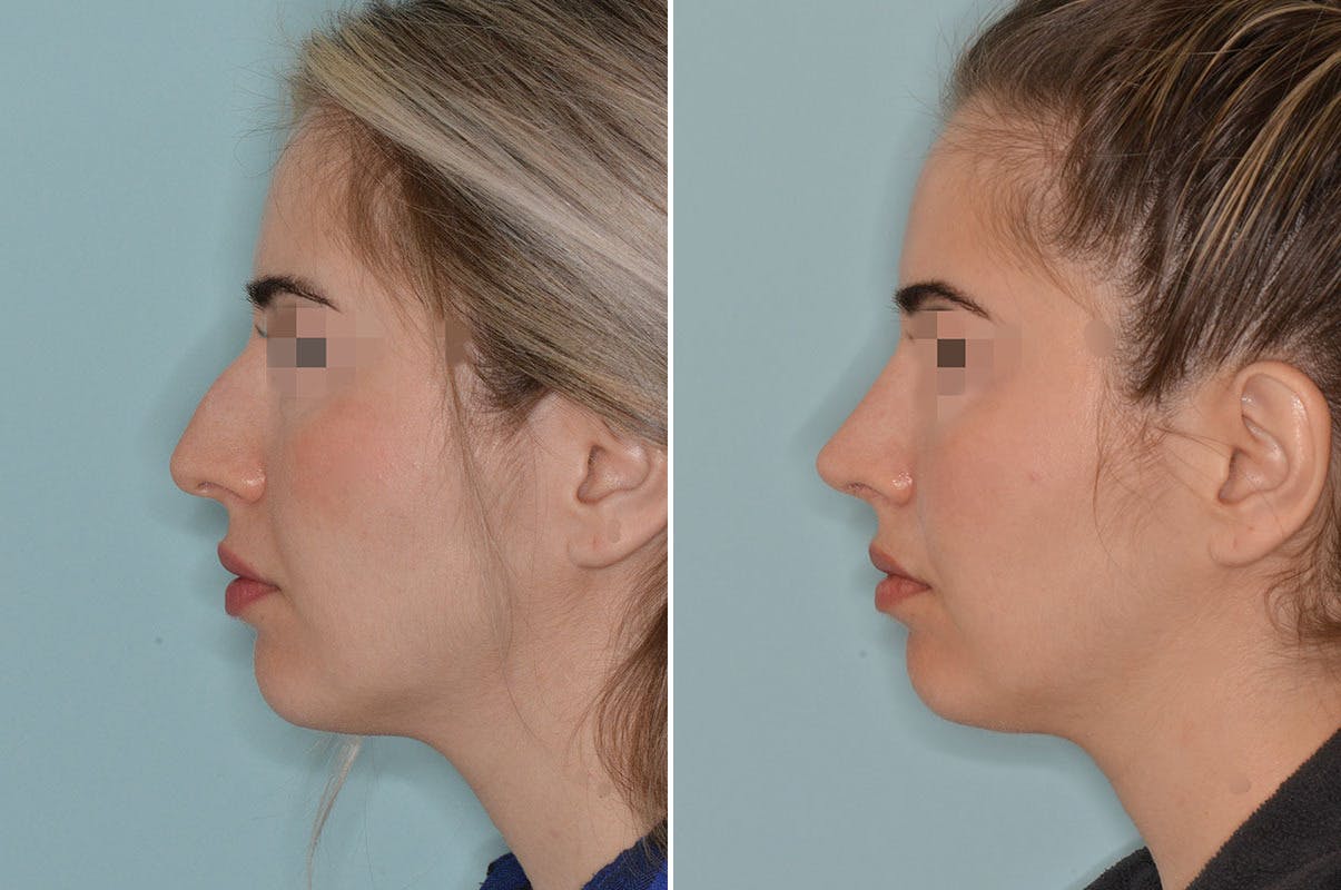 Rhinoplasty before and after, lateral left.