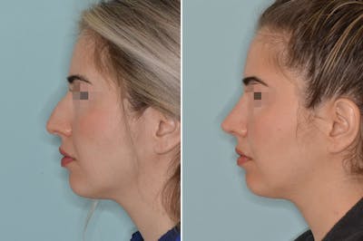 Rhinoplasty before and after, lateral left.