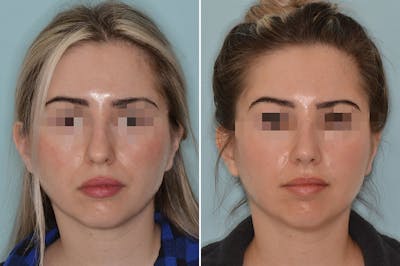 Rhinoplasty before and after, frontal.